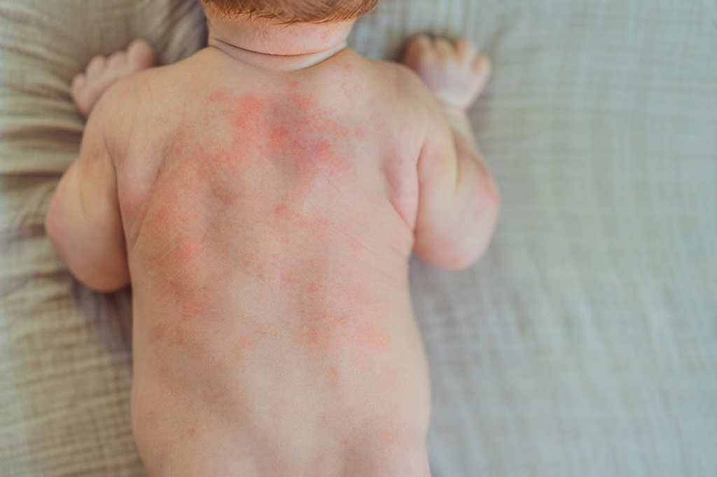 Eczema Back Rash
